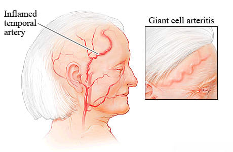 Illustration of Giant Cell Arteritis (GCA) / Arteritic AION