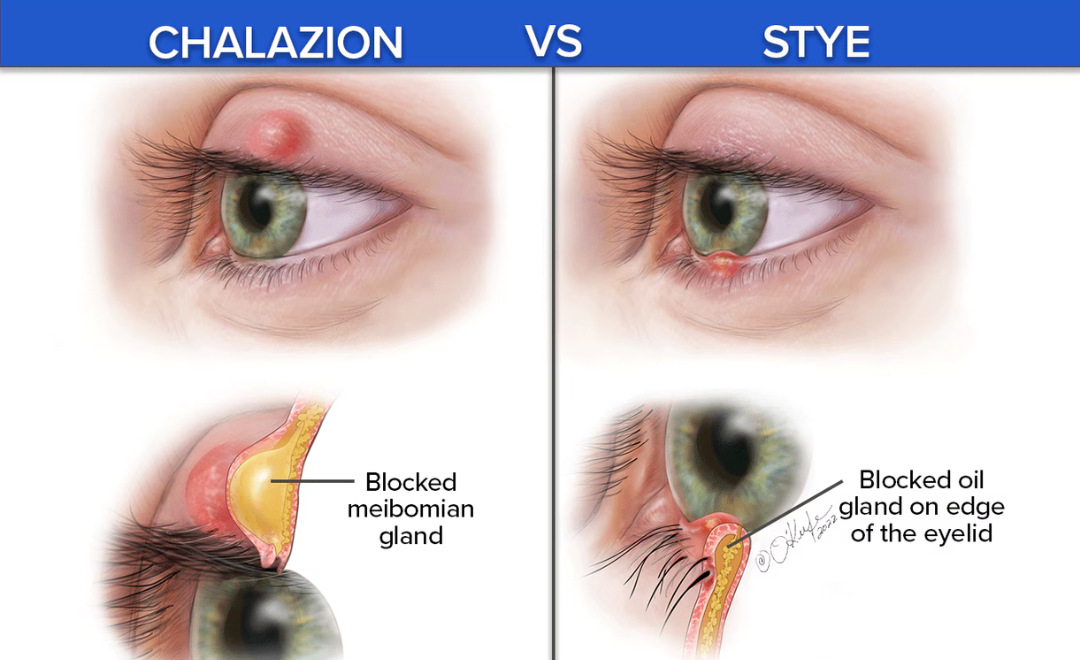 Illustration of Stye (Hordeolum) / Chalazion